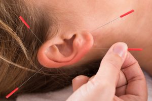 Akupunkturbehandlung, Anwendung am Ohr einer Frau