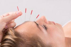 Akupunkturbehandlung, Anwendung im Gesichtsbereich einer Frau
